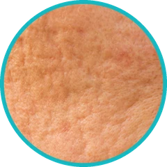 Peeling naturel sur les cicatrices superficielles — Kanea, Toulon