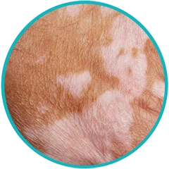 Gros plan de taches de vitiligo sur la peau — nanopigmentation Toulon, Kanea