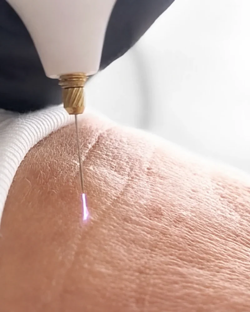Plasma russe au stylo, effet lifting naturel de la peau à Toulon